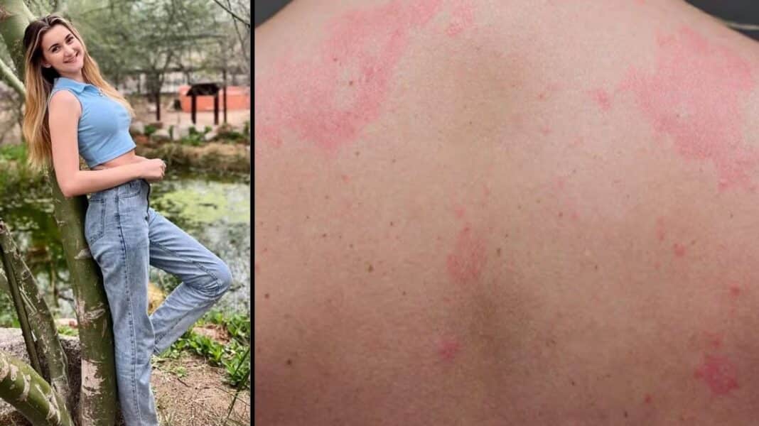Όταν το νερό προκαλεί κάψιμο και επώδυνες αντιδράσεις στο δέρμα - Η 15χρονη με τη σπάνια πάθηση που κάνει τη ζωή της κόλαση